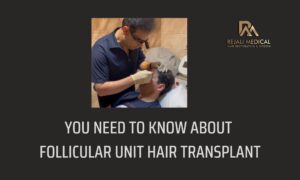 You Need to Know About Follicular Unit Hair Transplant