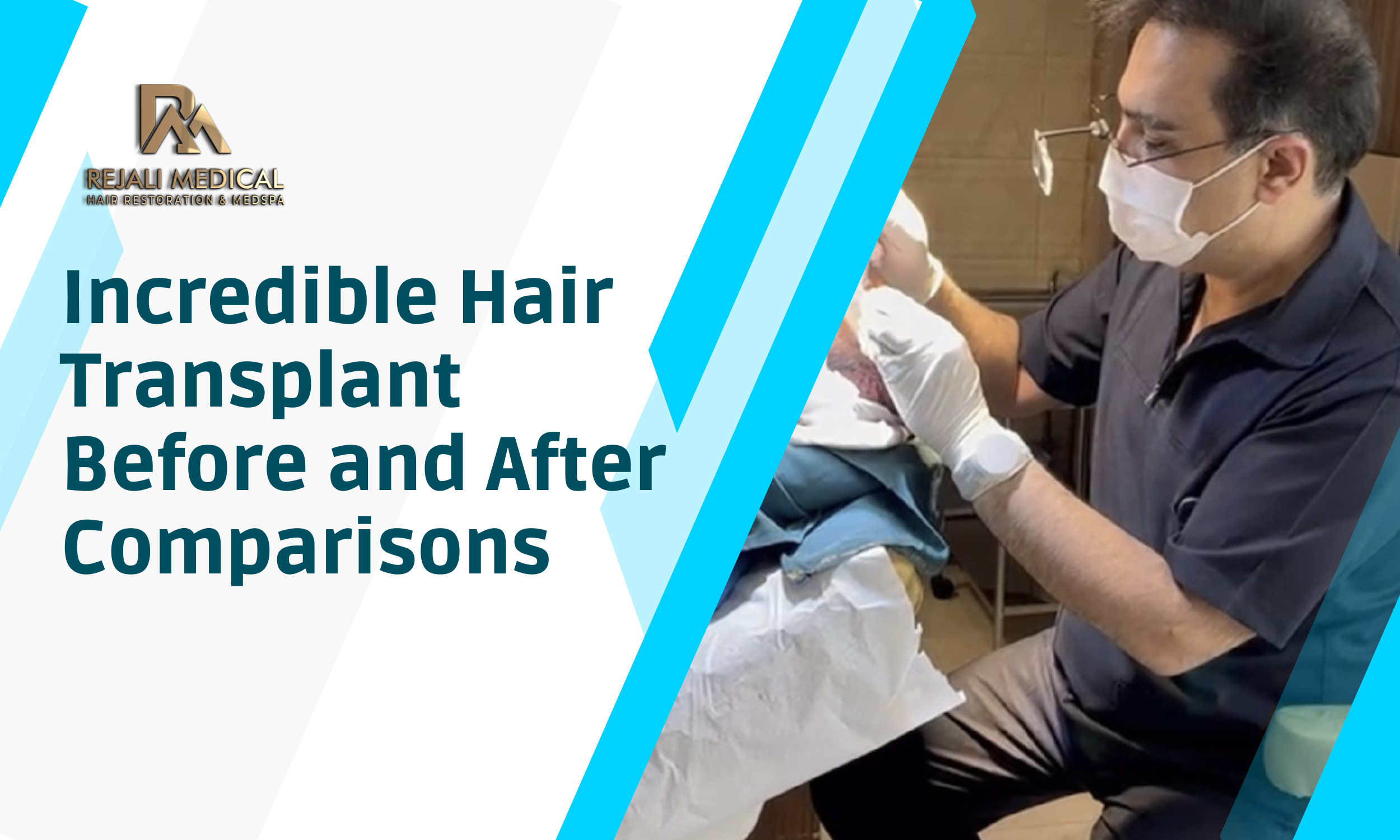 Incredible Hair Transplant Before and After Comparisons