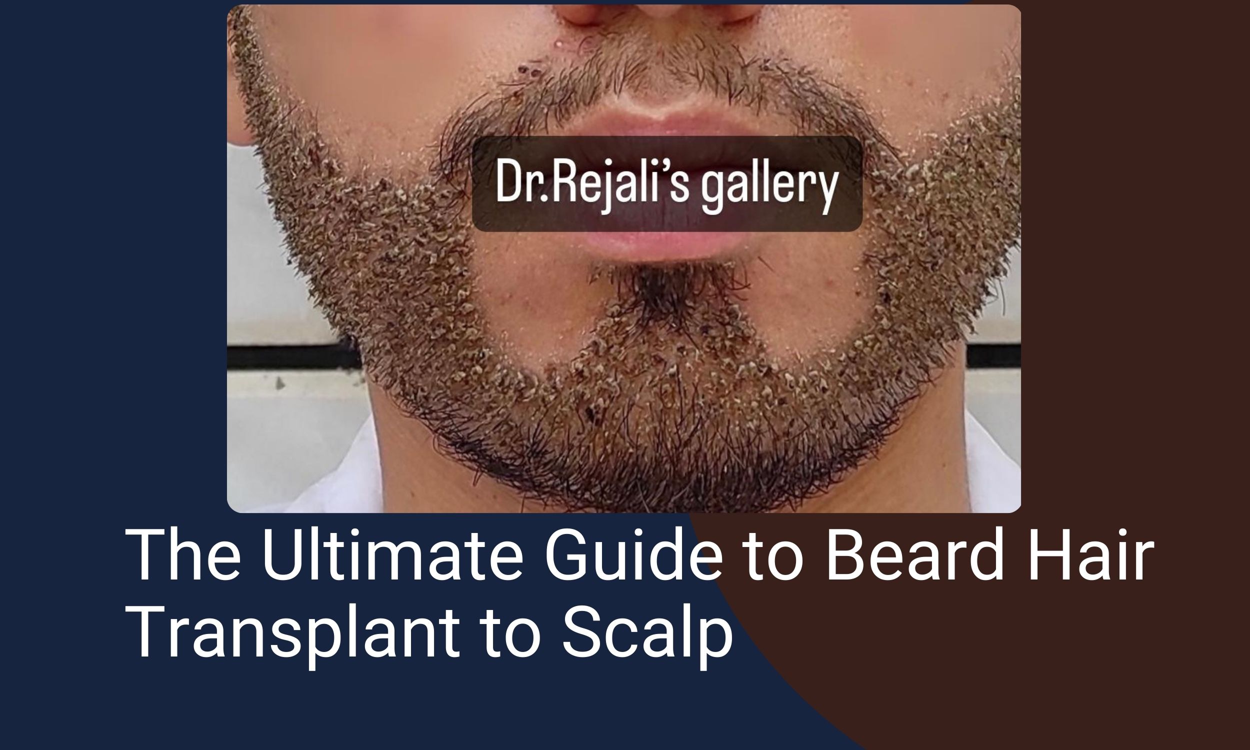 Beard Hair Transplant to Scalp