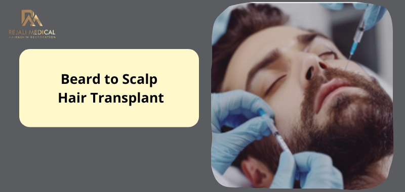 Beard-to-Scalp-Hair-Transplant