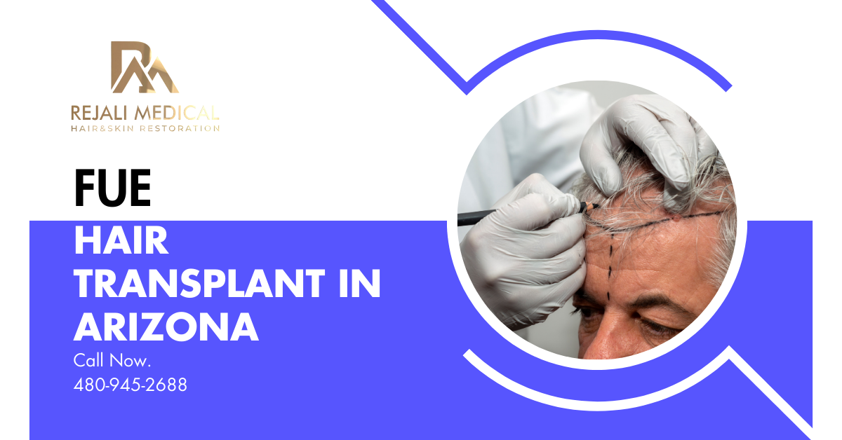 FUE Hair Transplant in Arizona