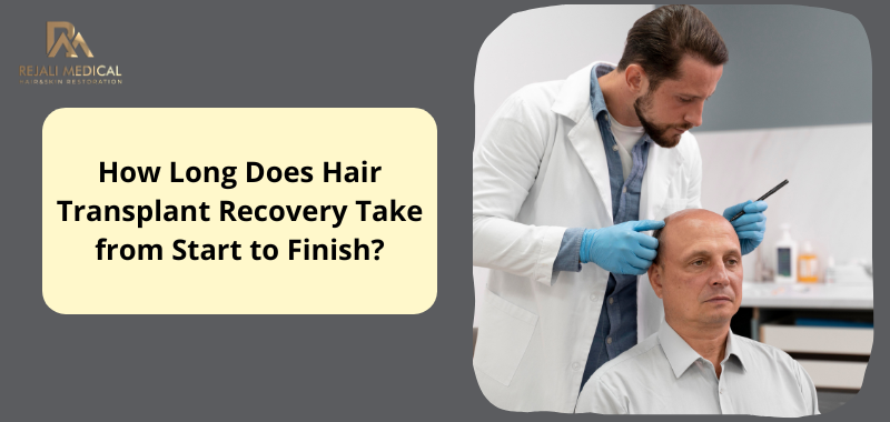 How Long Does Hair Transplant Recovery Take from Start to Finish?