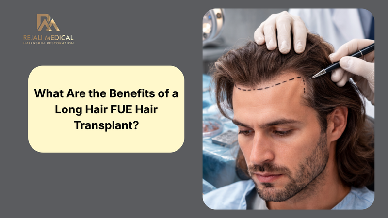 What Are the Benefits of a Long Hair FUE Hair Transplant?